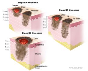 As shown in this diagram, melanoma progresses in three stages. As the cancer spreads deeper into one’s skin, the melanoma becomes more destructive and harder to remove. (Photo courtesy of The National Cancer Institute.)