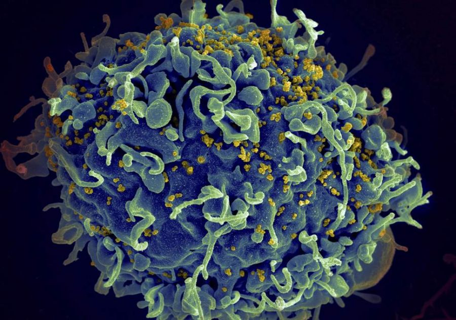 Pictured is a human immune cell (blue) being attacked by the human immunodeficiency virus (yellow). The effects of the virus were previously thought to only be stopped through the continuous use of antiretroviral drugs, but now this fact is being disproved. 
(National Institute of Allergy and Infectious Diseases/AP)